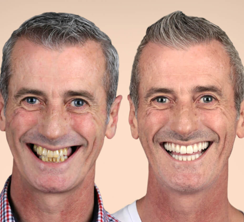 Fixed Teeth Australia Ballarat photo 2