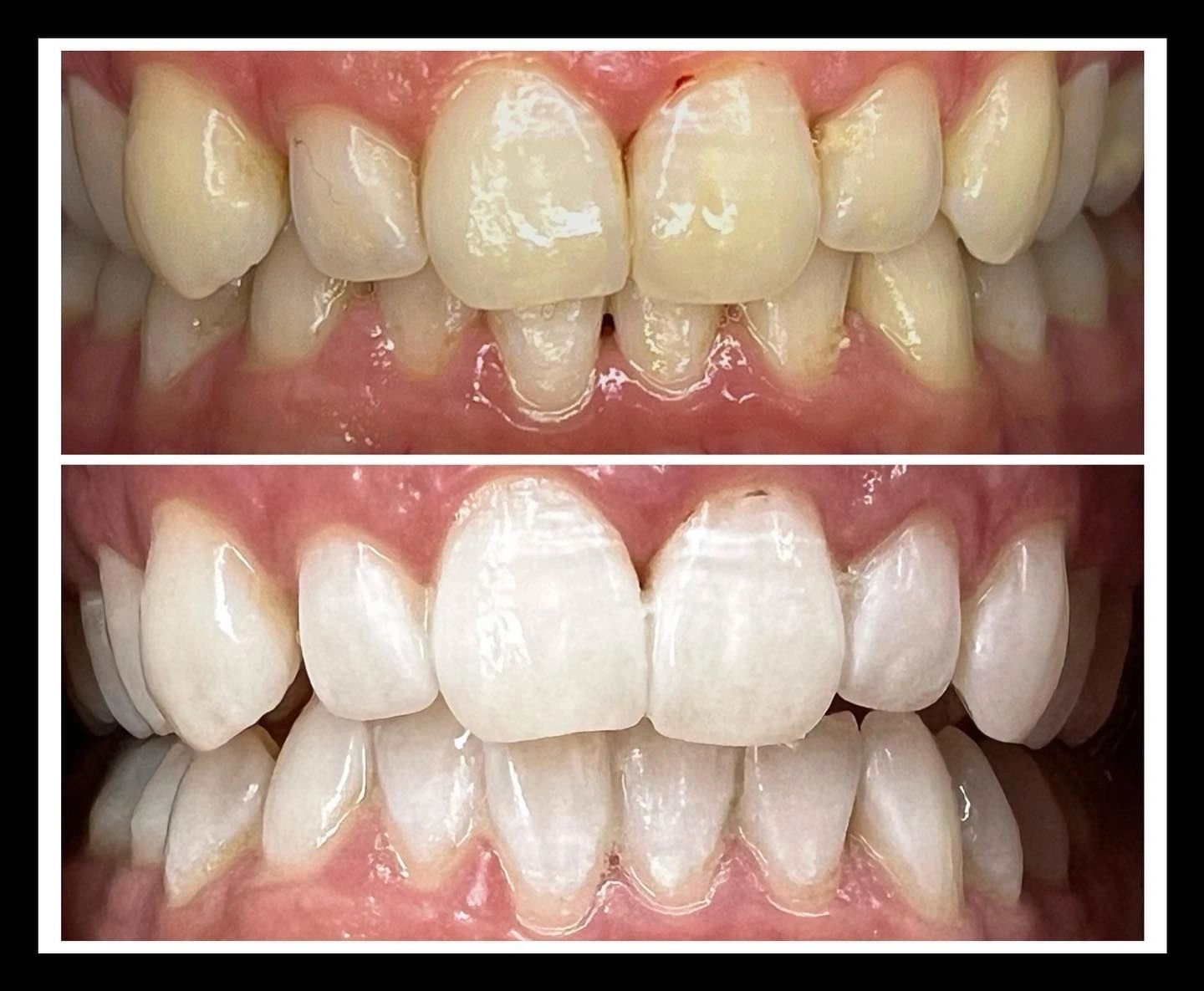 WHITEN UP TEETH WHITENING photo 4